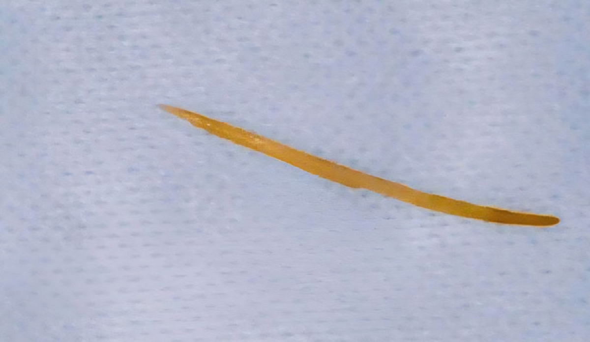 Người đàn ông 57 tuổi đau bụng thốc ngược lên, bác sĩ gắp ra thứ "đáng sợ" dài 5cm- Ảnh 1.