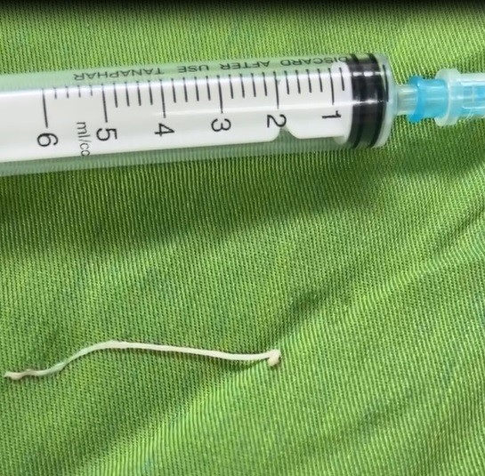 Đau bụng âm ỉ, đến viện bác sĩ gắp ra thứ "đáng sợ" bên trong - Ảnh 1.