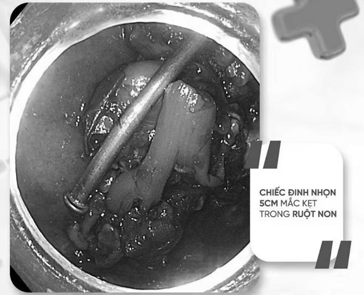 Bé trai 8 nghịch dại, bác sĩ kinh ngạc phát hiện thứ "đáng sợ" bên trong bụng - Ảnh 1.