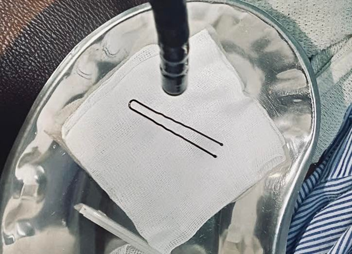 Bé gái 4 tuổi bỗng khóc to gia đình liền đưa đi viện, bác sĩ gắp ra thứ "đáng sợ" bên trong - Ảnh 1.