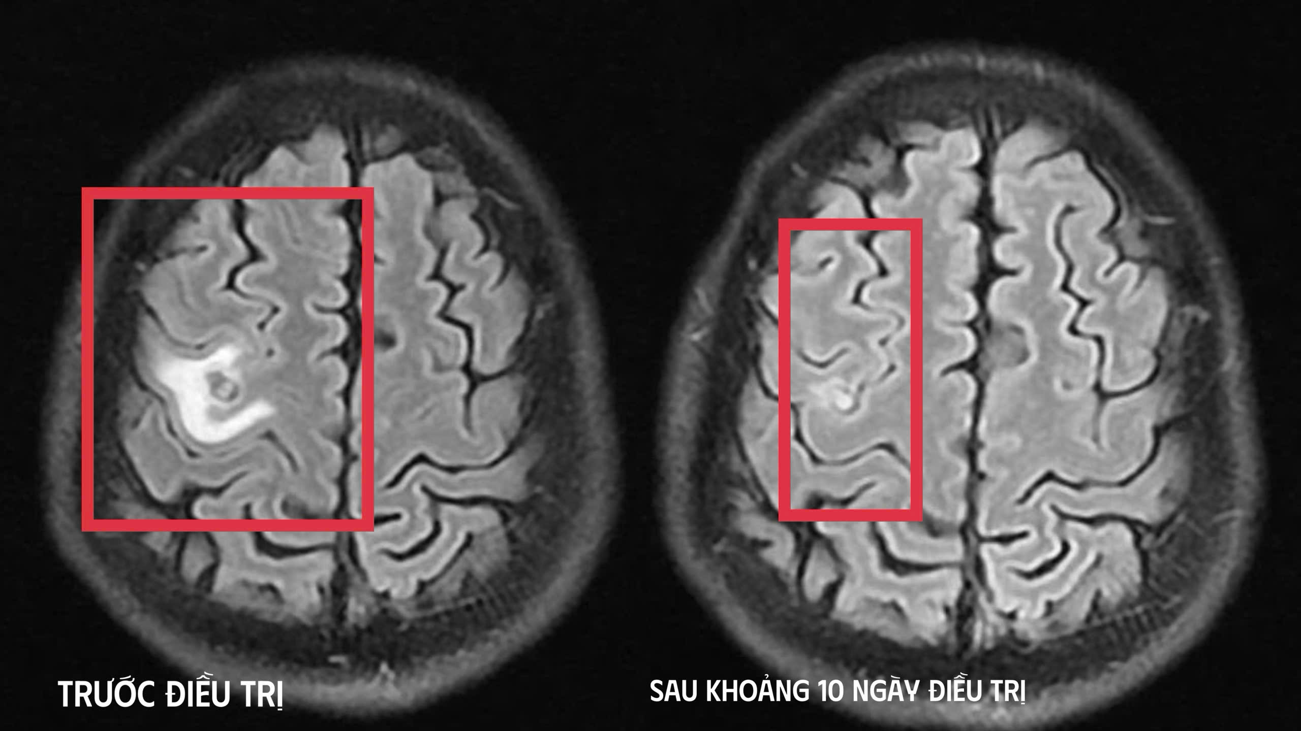 Cơn co giật bất thường hé lộ “vị khách lạ” ký sinh trong não- Ảnh 1.