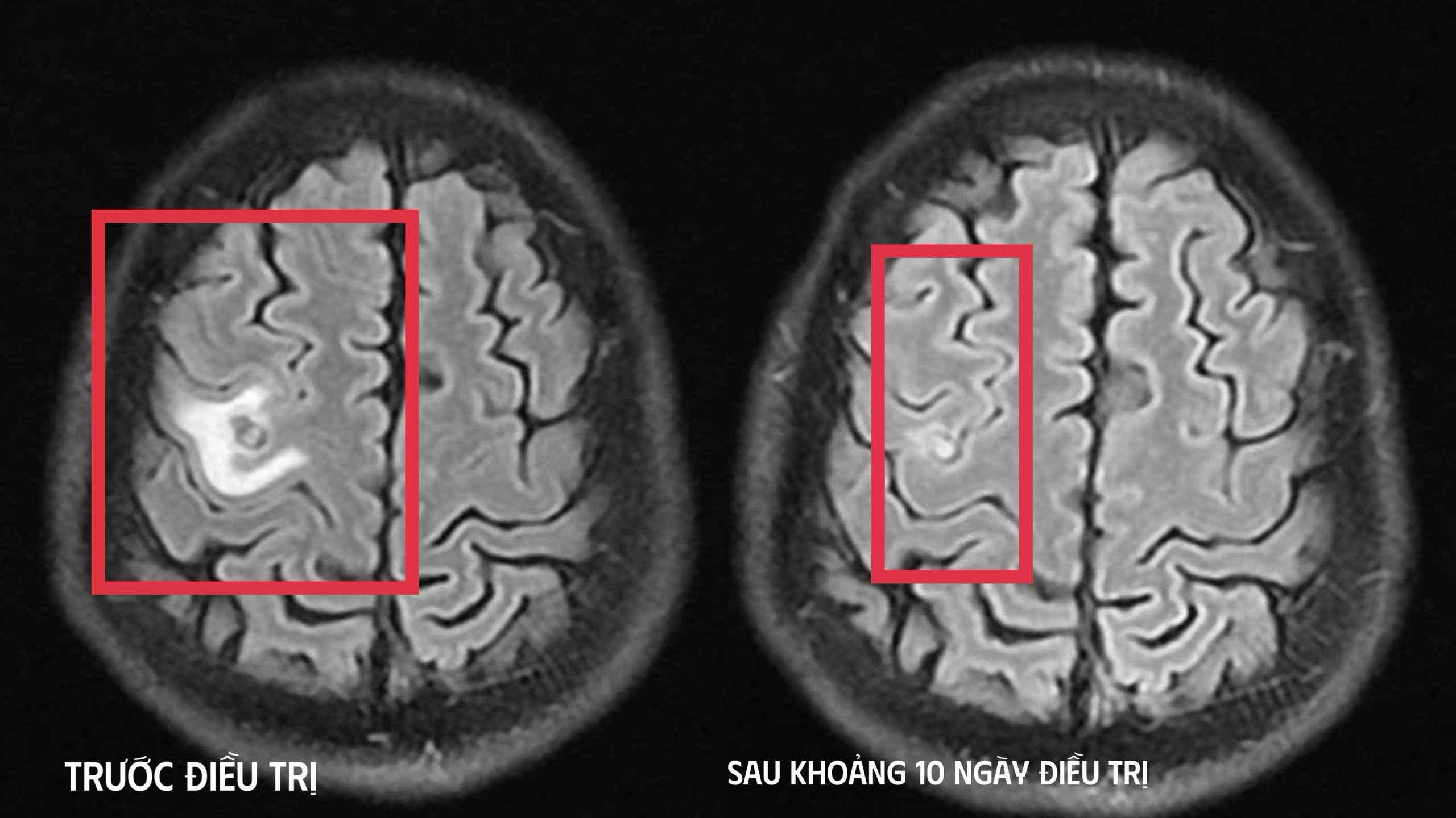 Người đàn ông 39 tuổi co giật, đâu đầu, đến viện bác sĩ phát hiện thứ "đáng sợ" bên trong - Ảnh 1.
