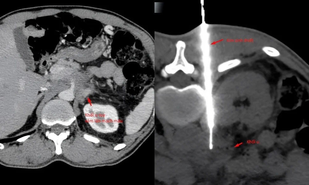 Tuyệt thực 3 tuần để "bỏ đói" khối u chữa ung thư, người đàn ông suy kiệt nặng - Ảnh 1.