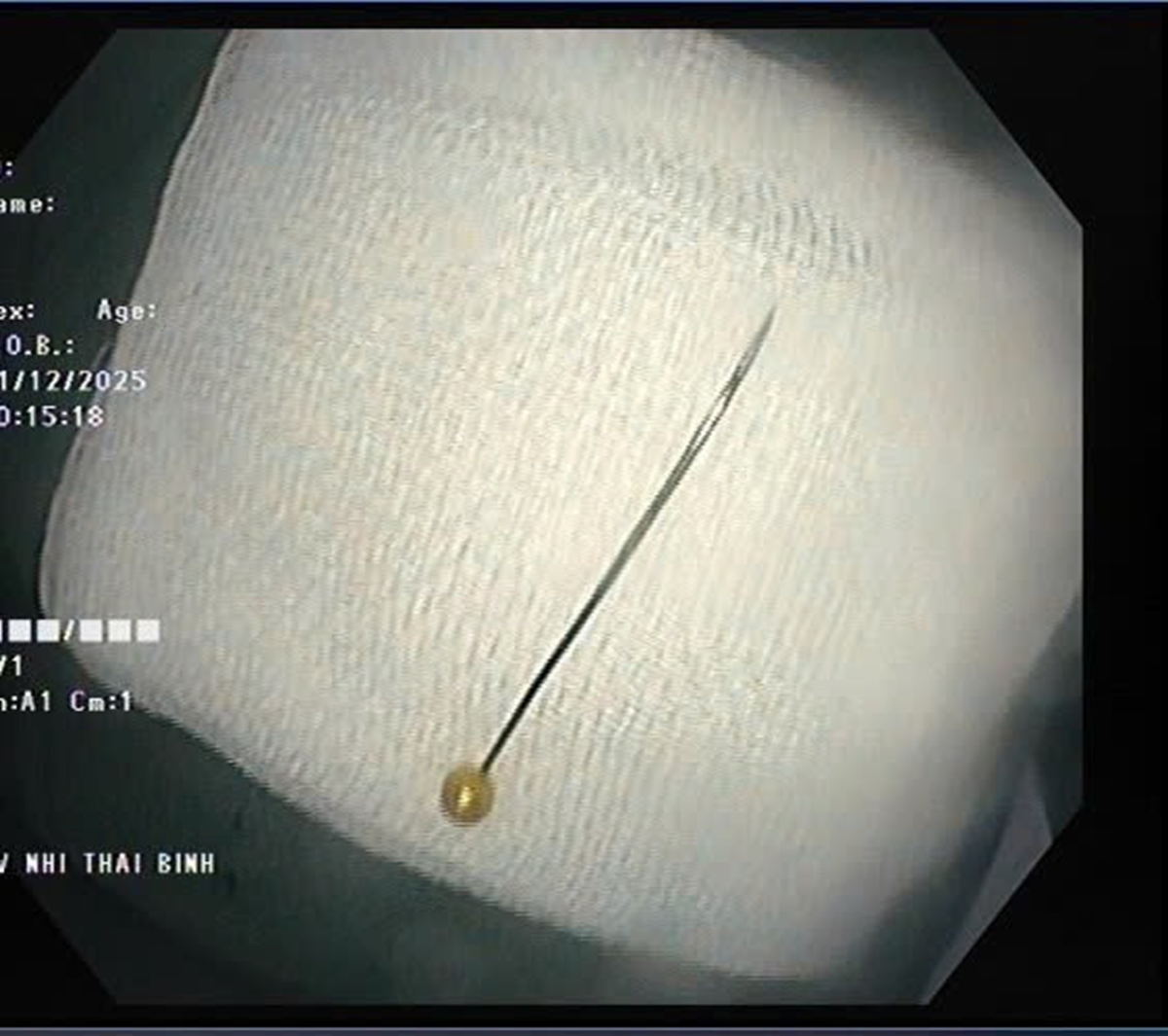 Bé trai 11 tháng khó chịu trong người, bác sĩ gắp ra thứ "đáng sợ" - Ảnh 2.