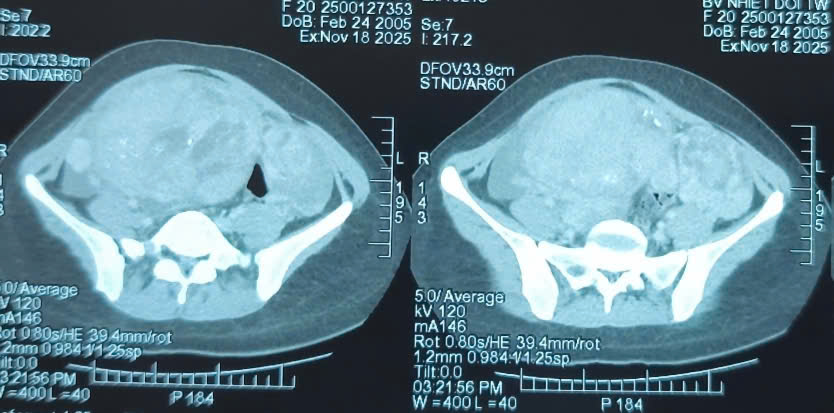 Khối u buồng trứng khổng lồ chiếm gần trọn bụng dưới của bệnh nhân 20 tuổi- Ảnh 1. Khối u buồng trứng khổng lồ chiếm gần trọn bụng dưới của bệnh nhân 20 tuổi- Ảnh 1.