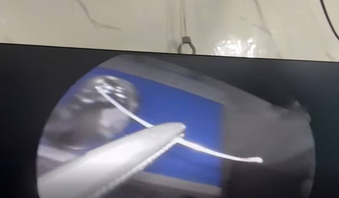 Người đàn ông đau họng dữ dội, bác sĩ gắp ra thứ "đáng sợ" bên trong - Ảnh 1.