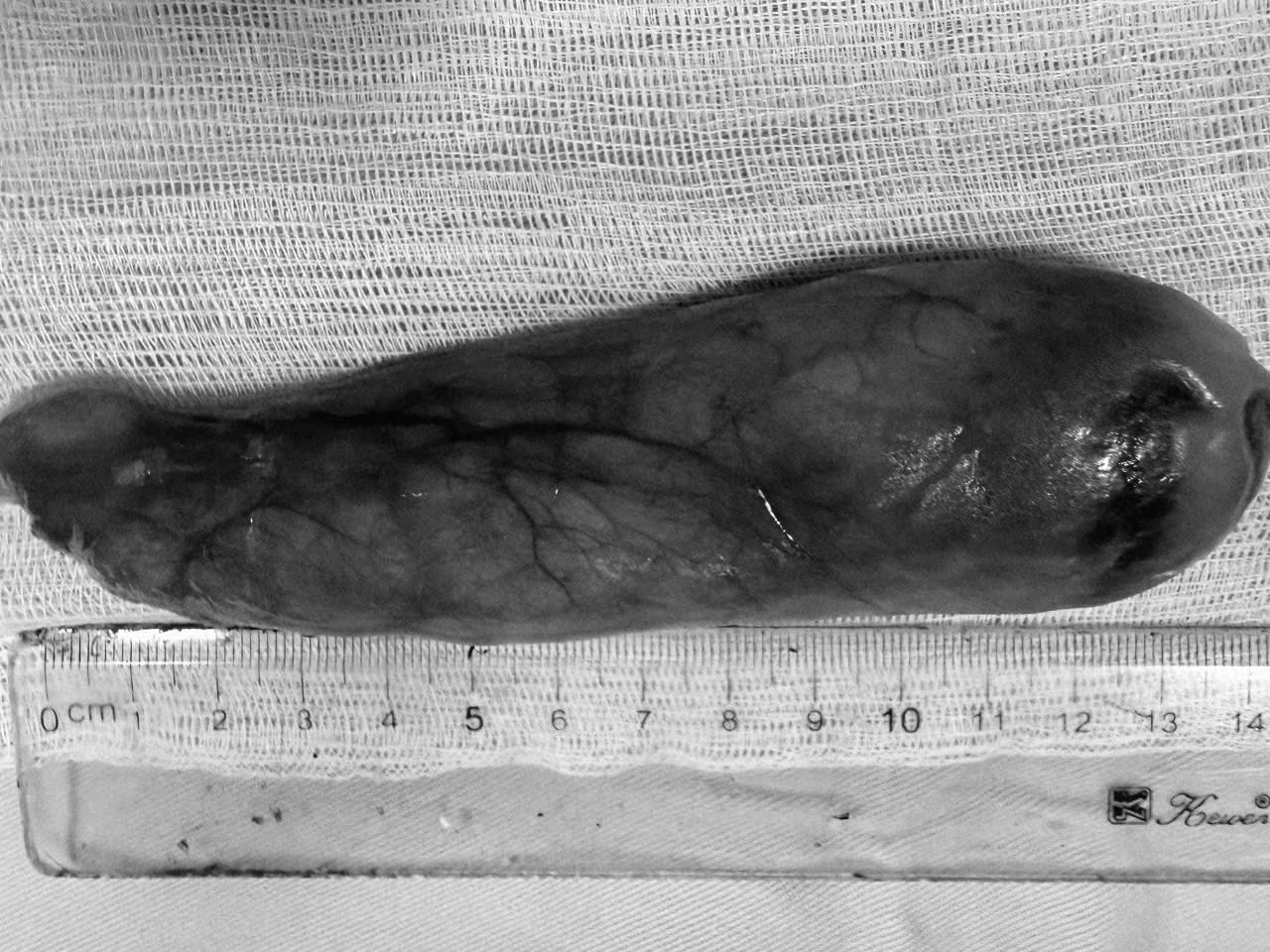 Người phụ nữ 59 tuổi nuốt nghẹn cả tháng trời, bác sĩ gắp ra thứ "đáng sợ" dài 16 cm - Ảnh 1.