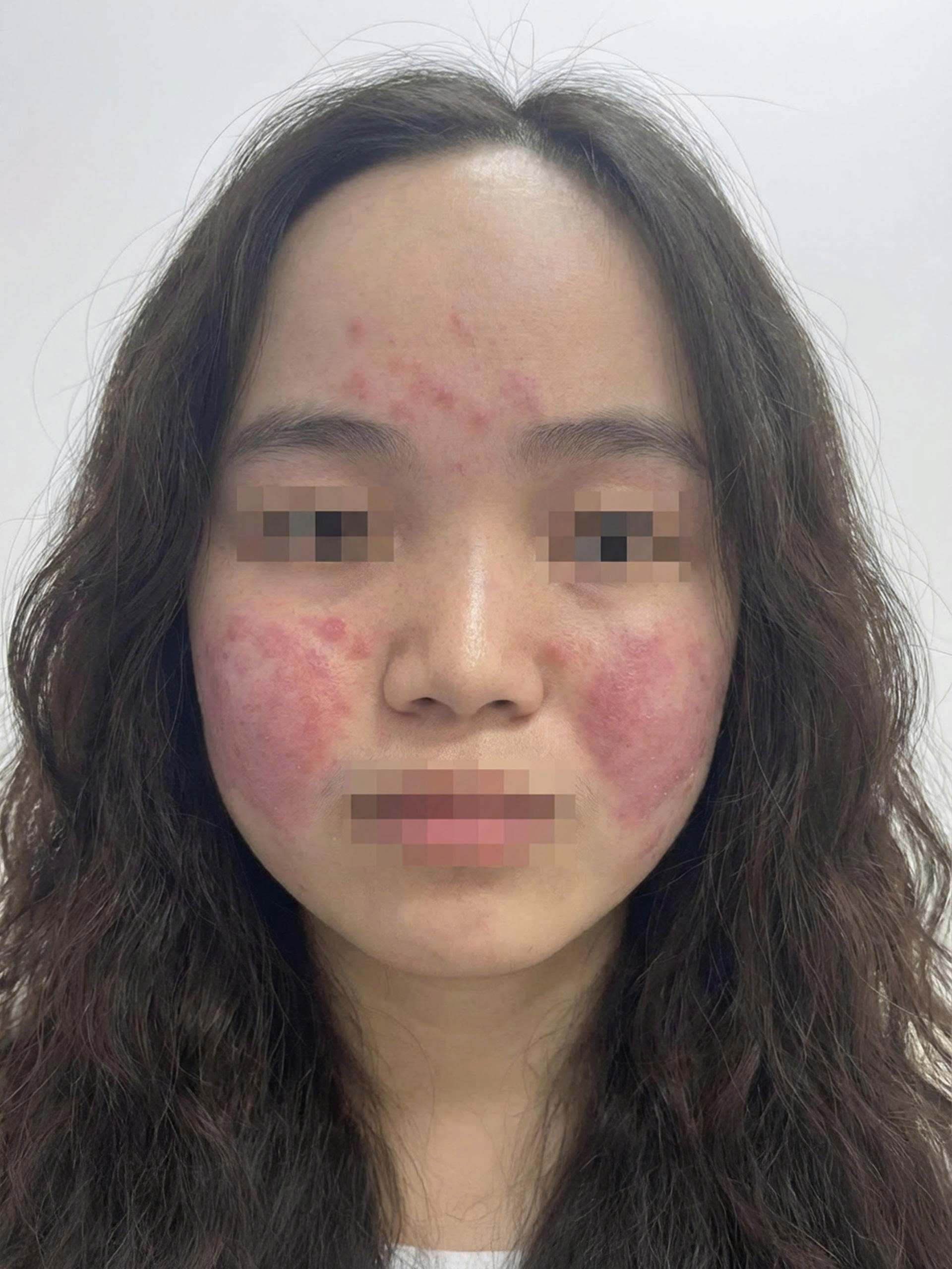 Tiếp xúc ô nhiễm không khí, chuyên gia cảnh báo gia tăng bệnh về da- Ảnh 2. Tiếp xúc ô nhiễm không khí, chuyên gia cảnh báo gia tăng bệnh về da- Ảnh 2.