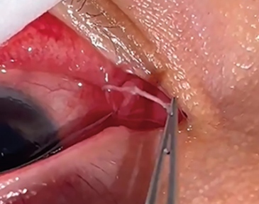 Người phụ nữ đau mắt đi khám, bác sĩ gắp ra thứ "đáng sợ" bên trong- Ảnh 1. Người phụ nữ đau mắt đi khám, bác sĩ gắp ra thứ "đáng sợ" bên trong- Ảnh 1.