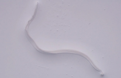 Người phụ nữ đau mắt đi khám, bác sĩ gắp ra thứ "đáng sợ" bên trong- Ảnh 2. Người phụ nữ đau mắt đi khám, bác sĩ gắp ra thứ "đáng sợ" bên trong- Ảnh 2.