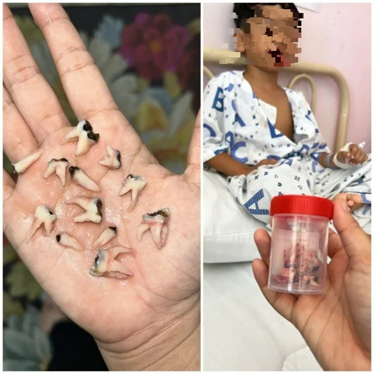 Bé trai bị nhổ 12 chiếc răng liền một lúc vì thói quen "vạn người mê" - Ảnh 1.