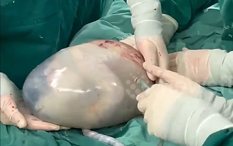 Người phụ nữ sinh con nặng 6,2kg - Ảnh 2.