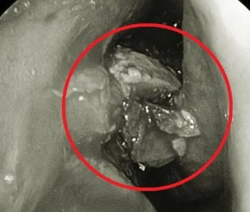 Khám mũi cho người phụ nữ 50 tuổi, bác sĩ phát hiện thứ đáng sợ- Ảnh 1.