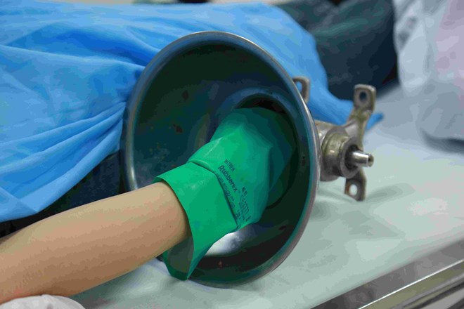 Người phụ nữ 36 tuổi suýt mất bàn tay khi sử dụng máy xay thịt- Ảnh 1.