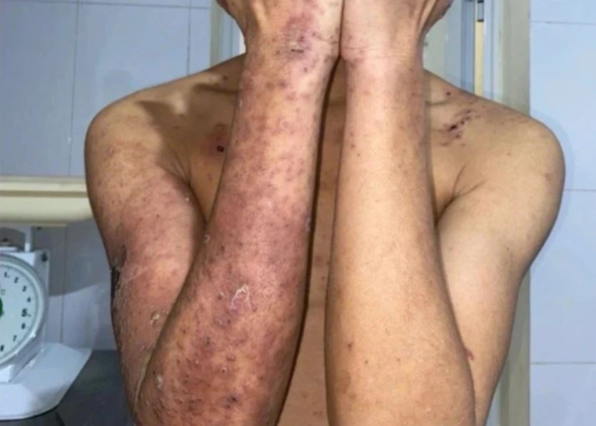 Đắp kiến ba khoang chữa ngứa, nam thanh niên gánh hậu quả- Ảnh 1. Đắp kiến ba khoang chữa ngứa, nam thanh niên gánh hậu quả- Ảnh 1.