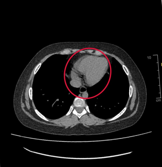 Sau khi bị đau bụng, nôn ói, bé gái 9 tuổi phải cắt bỏ 1 bên buồng trứng- Ảnh 1. Sau khi bị đau bụng, nôn ói, bé gái 9 tuổi phải cắt bỏ 1 bên buồng trứng- Ảnh 1.