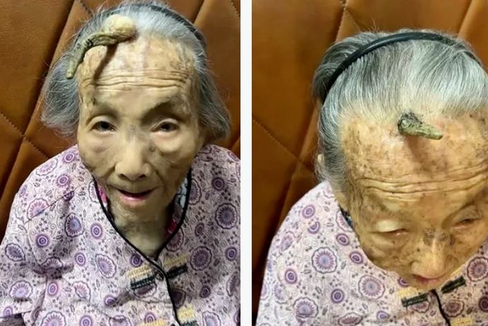 Nam thanh niên 30 tuổi bỗng dưng mọc sừng sau đầu- Ảnh 2. Nam thanh niên 30 tuổi bỗng dưng mọc sừng sau đầu- Ảnh 2.