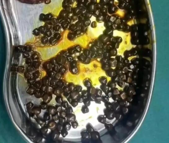 Bé gái 10 tuổi thường xuyên bỏ bữa sáng, đi khám bố mẹ "sốc nặng" khi bác sĩ lấy ra thứ này- Ảnh 1. Bé gái 10 tuổi thường xuyên bỏ bữa sáng, đi khám bố mẹ "sốc nặng" khi bác sĩ lấy ra thứ này- Ảnh 1.