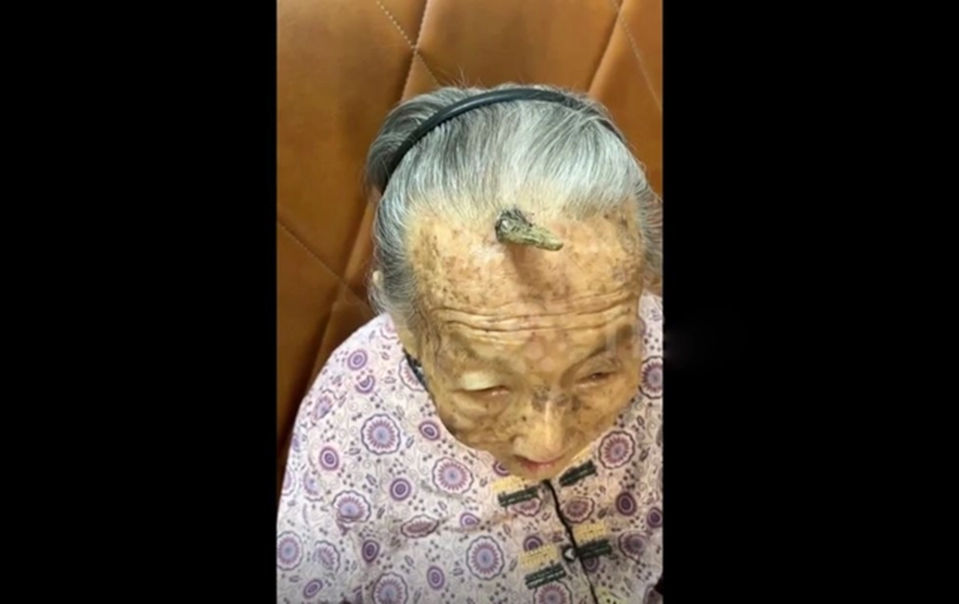 Cụ bà 107 tuổi bỗng mọc "sừng" trên trán, cộng đồng mạng bàn tán đưa ra lời khuyên- Ảnh 1. Cụ bà 107 tuổi bỗng mọc "sừng" trên trán, cộng đồng mạng bàn tán đưa ra lời khuyên- Ảnh 1.