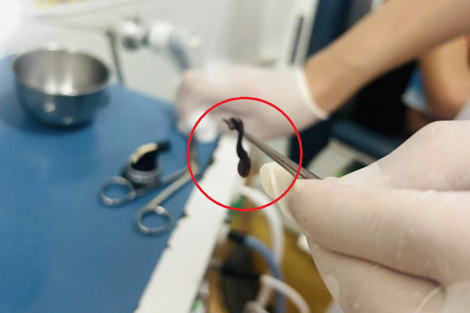 Thấy chảy máu mũi kéo dài, bé trai đến viện bác sĩ gắp ra thứ "đáng sợ"- Ảnh 1. Thấy chảy máu mũi kéo dài, bé trai đến viện bác sĩ gắp ra thứ "đáng sợ"- Ảnh 1.