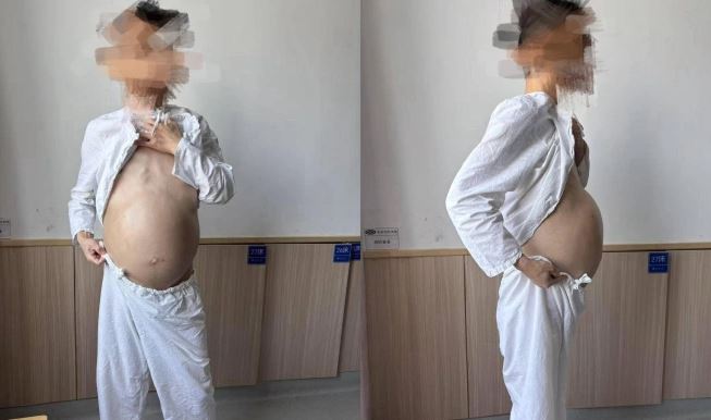 Người đàn ông 40 tuổi bụng to như mang bầu, khi phẫu thuật bác sĩ phát hiện điều đáng sợ- Ảnh 1. Người đàn ông 40 tuổi bụng to như mang bầu, khi phẫu thuật bác sĩ phát hiện điều đáng sợ- Ảnh 1.