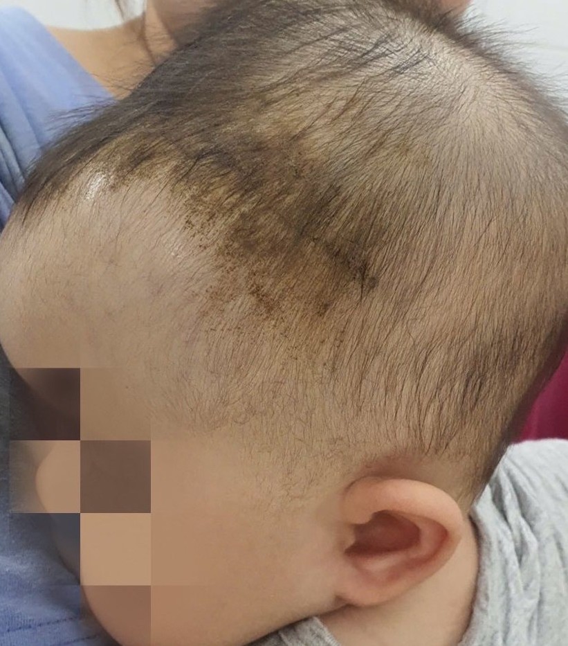 Bé 7 tuổi chấn thương nặng sau cú ngã tưởng vô hại- Ảnh 1. Bé 7 tuổi chấn thương nặng sau cú ngã tưởng vô hại- Ảnh 1.