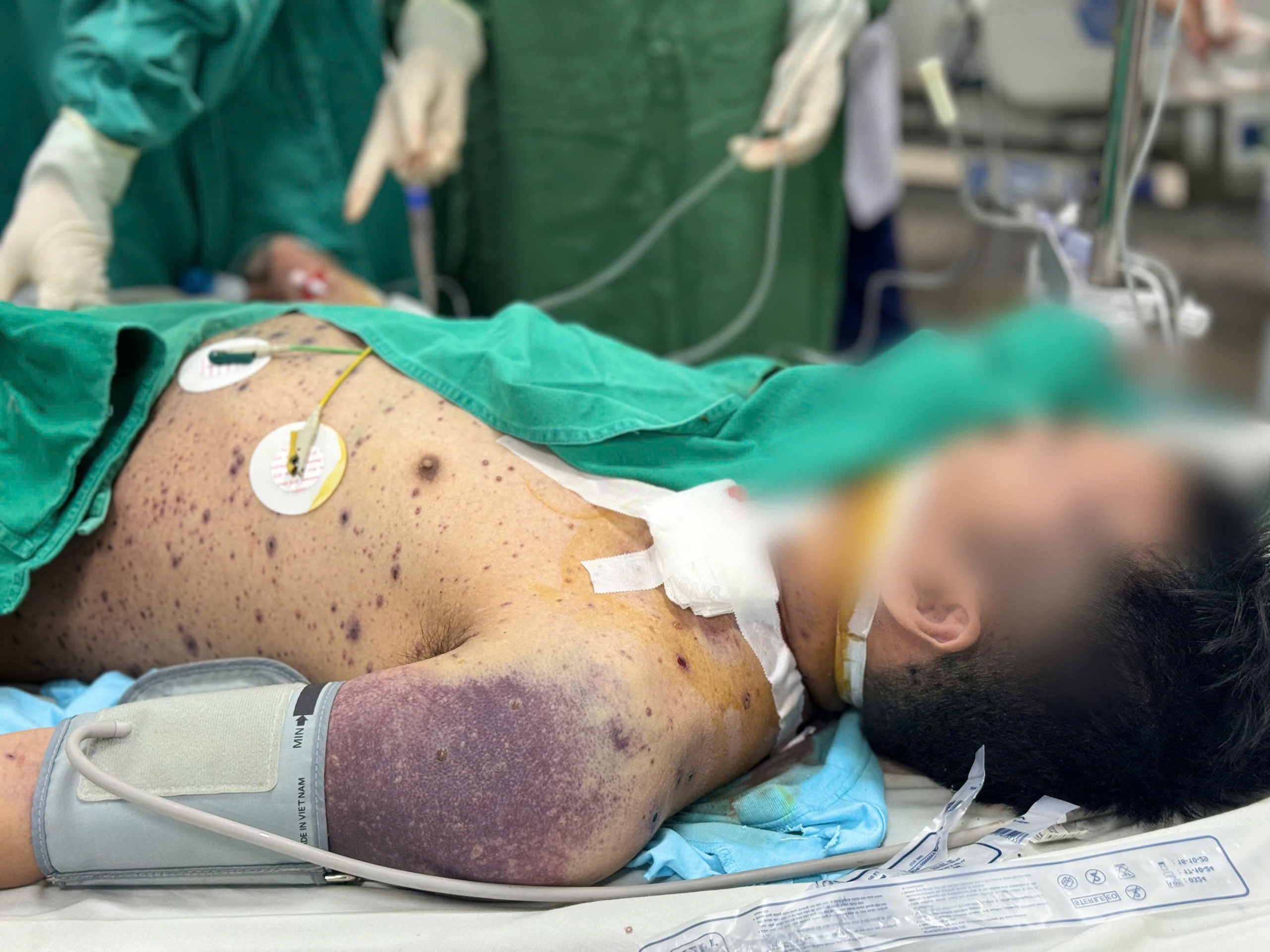 Hai nam thanh niên rơi vào nguy kịch vì biến chứng thủy đậu- Ảnh 1. Hai nam thanh niên rơi vào nguy kịch vì biến chứng thủy đậu- Ảnh 1.