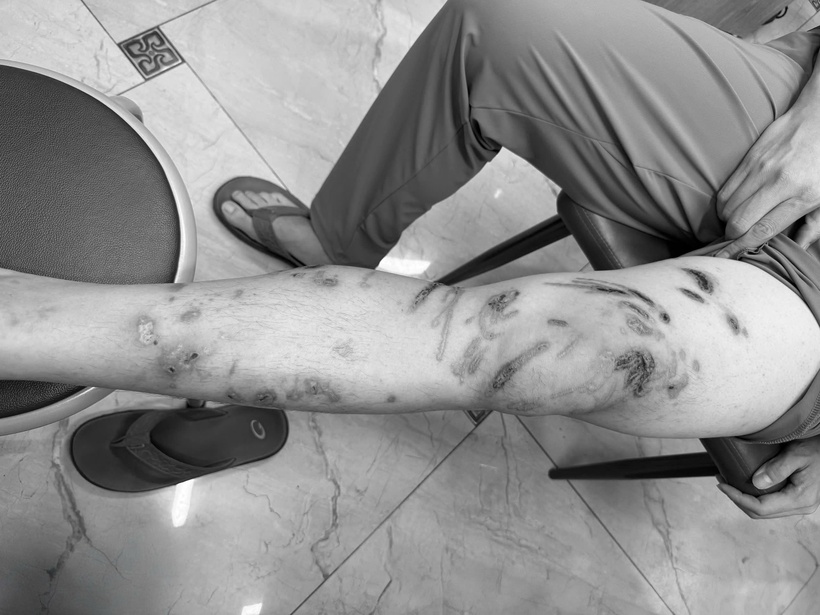 Người đàn ông bỏng rát toàn bộ chân trái sau 15 phút tắm biển- Ảnh 1. Người đàn ông bỏng rát toàn bộ chân trái sau 15 phút tắm biển- Ảnh 1.
