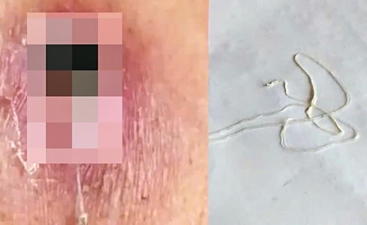 Người đàn ông 44 tuổi nhiễm loại ký sinh trùng hiếm gặp dài hàng mét- Ảnh 1. Người đàn ông 44 tuổi nhiễm loại ký sinh trùng hiếm gặp dài hàng mét- Ảnh 1.