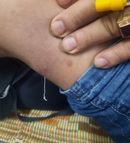 Người đàn ông 44 tuổi nhiễm loại ký sinh trùng hiếm gặp dài hàng mét- Ảnh 2. Người đàn ông 44 tuổi nhiễm loại ký sinh trùng hiếm gặp dài hàng mét- Ảnh 2.
