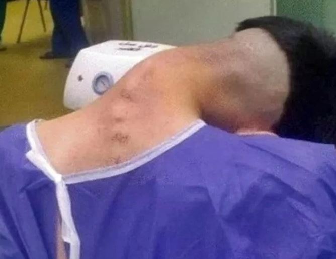 Thường xuyên làm việc này, chàng trai 23 tuổi mắc "hội chứng đầu gục"- Ảnh 1. Thường xuyên làm việc này, chàng trai 23 tuổi mắc "hội chứng đầu gục"- Ảnh 1.