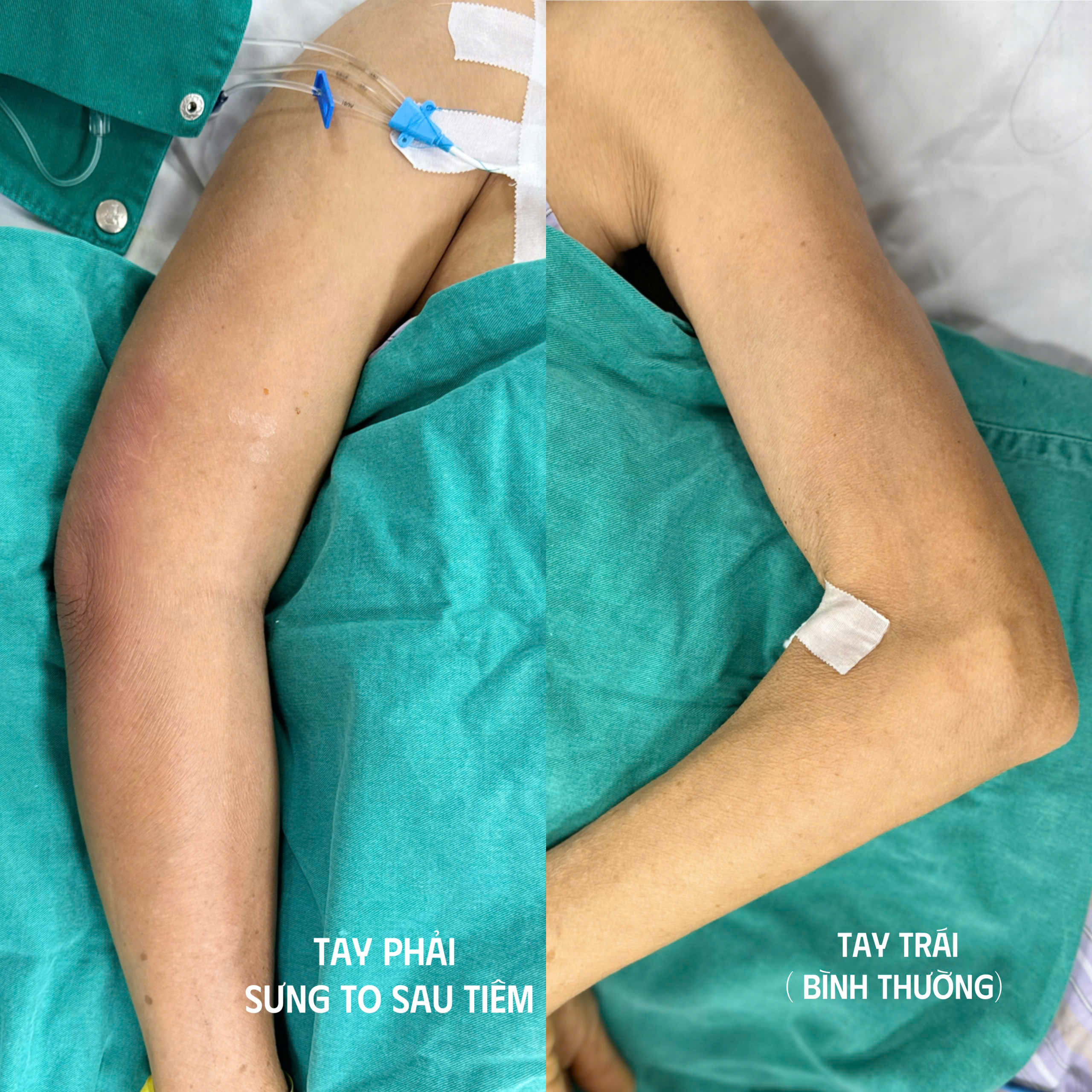 Sốc nhiễm khuẩn nặng sau khi tiêm khớp vai tại phòng khám tư- Ảnh 1. Sốc nhiễm khuẩn nặng sau khi tiêm khớp vai tại phòng khám tư- Ảnh 1.