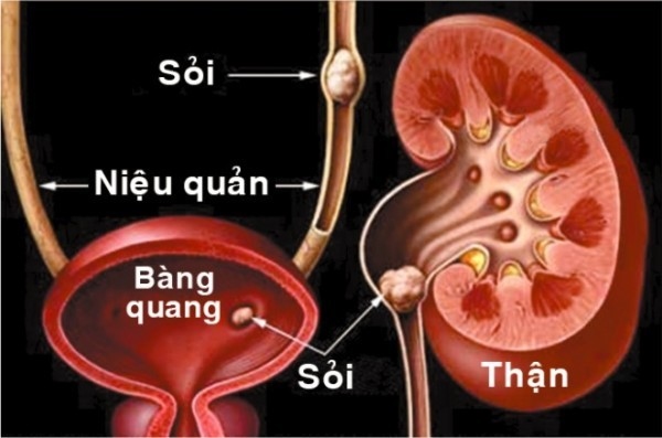 Sỏi tiết niệu hiểm hoạ thầm lặng có thể gây suy thận và tử vong- Ảnh 1. Sỏi tiết niệu hiểm hoạ thầm lặng có thể gây suy thận và tử vong- Ảnh 1.