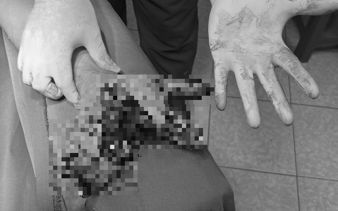 Người đàn ông 42 bị dập nát bàn tay vì thói quen khó bỏ