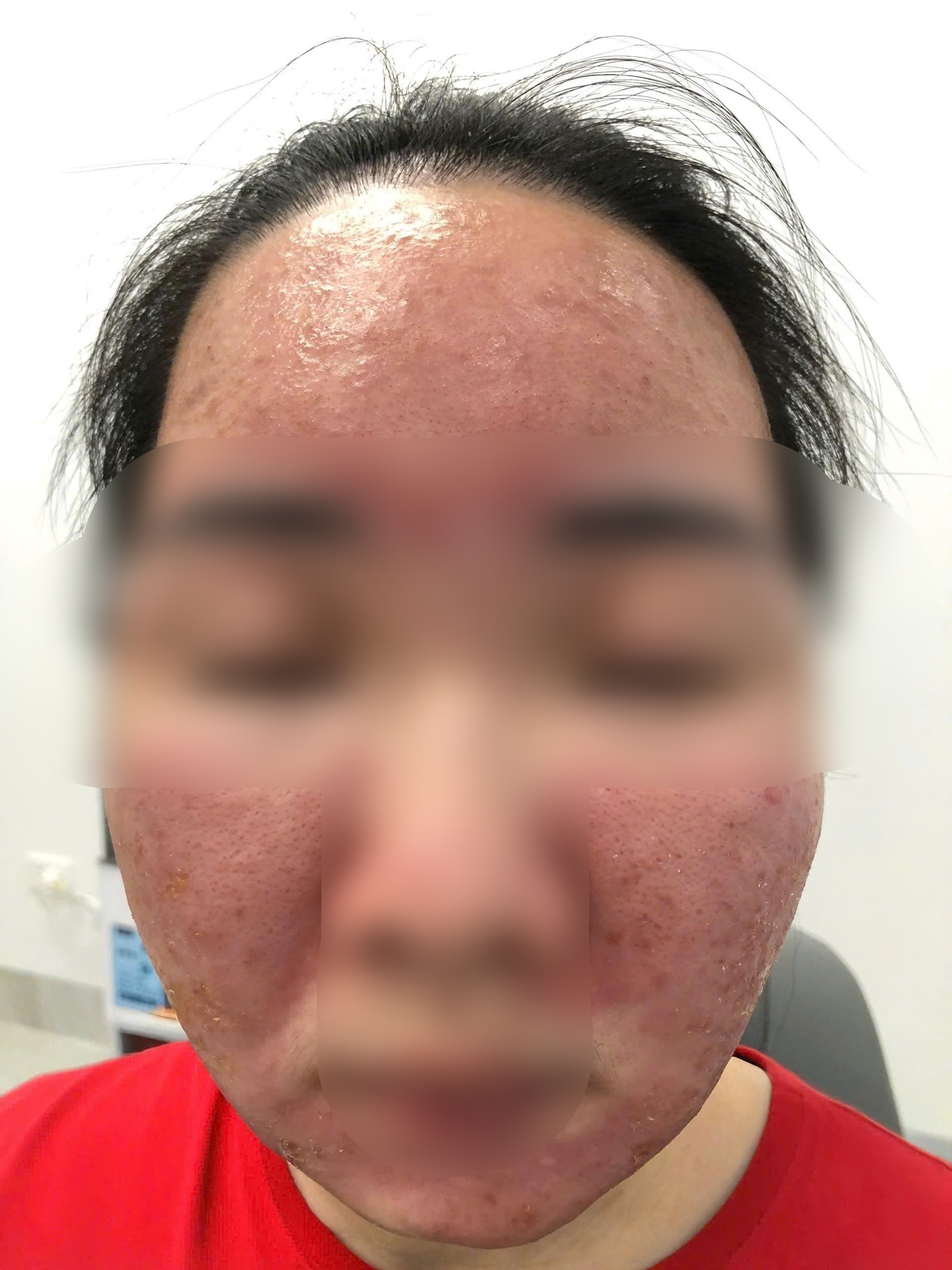 Nữ sinh Hà Nội "cháy da" vì tin lời quảng cáo kem chống nắng giá rẻ trên mạng- Ảnh 1. Nữ sinh Hà Nội "cháy da" vì tin lời quảng cáo kem chống nắng giá rẻ trên mạng- Ảnh 1.
