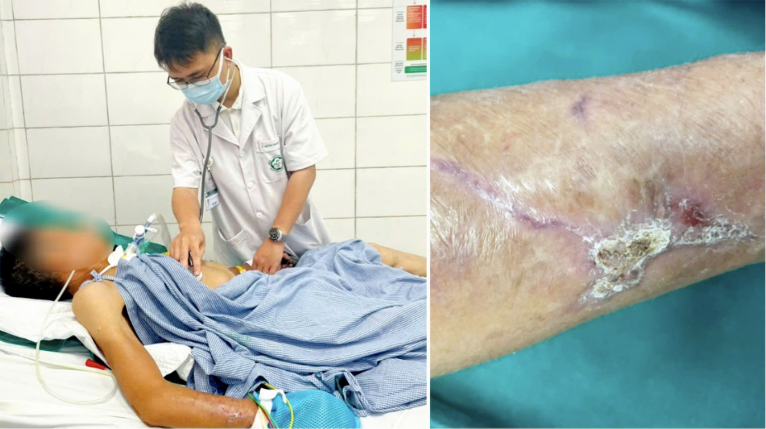 Cụ bà 90 tuổi mắc uốn ván, 5 người con tức tốc đi tiêm phòng- Ảnh 2. Cụ bà 90 tuổi mắc uốn ván, 5 người con tức tốc đi tiêm phòng- Ảnh 2.