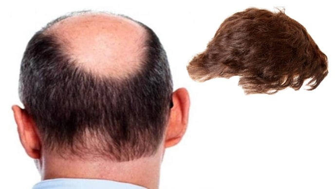 Cô dâu ngất xỉu khi phát hiện chú rể bị hói đầu trong đám cưới- Ảnh 1. Cô dâu ngất xỉu khi phát hiện chú rể bị hói đầu trong đám cưới- Ảnh 1.