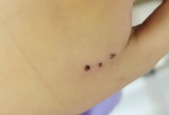 Bé 10 tuổi nhập viện sau khi bị chuột cắn- Ảnh 1. Bé 10 tuổi nhập viện sau khi bị chuột cắn- Ảnh 1.