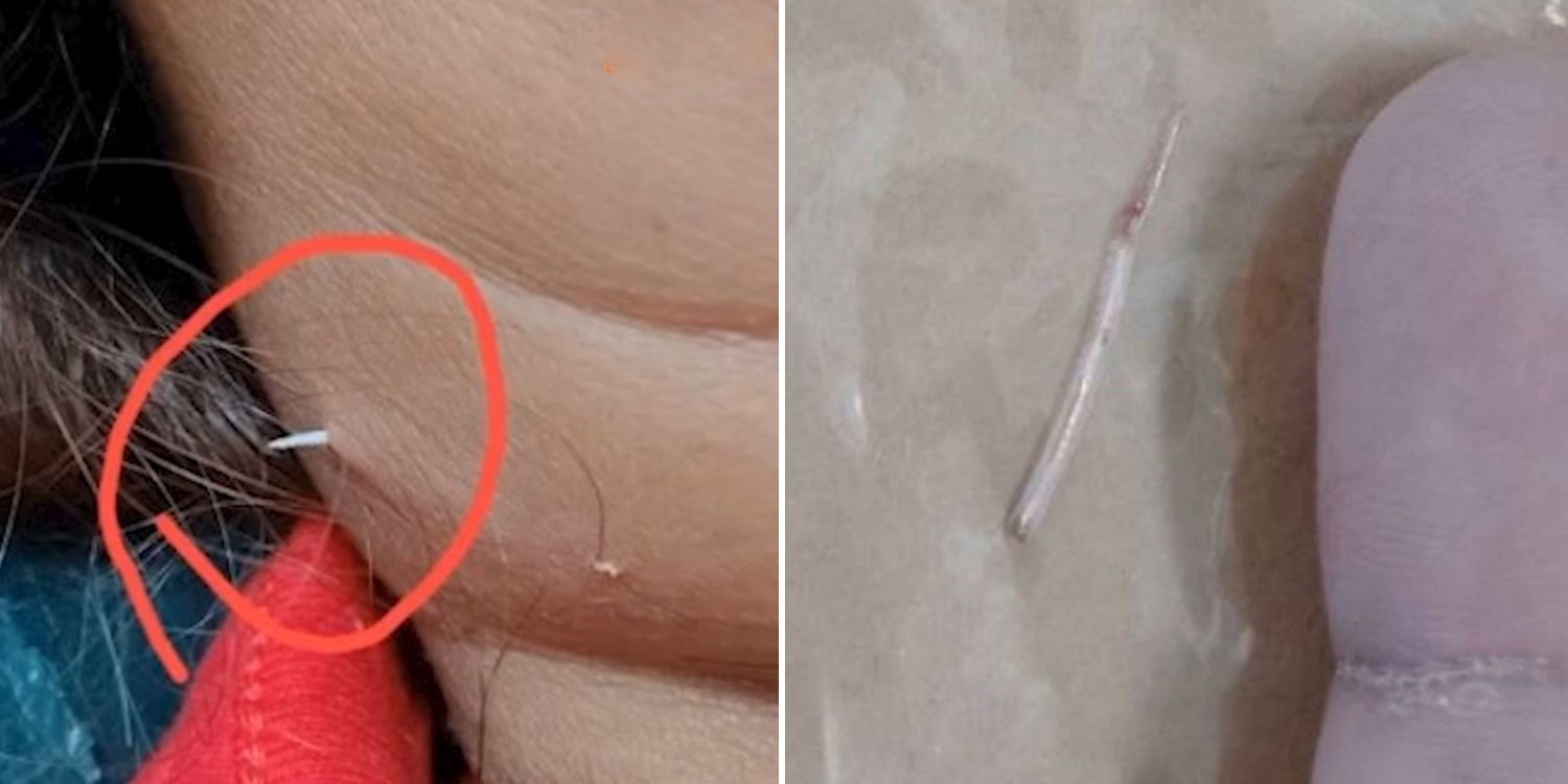 Đau cổ, người phụ nữ sốc nặng khi thấy thứ nhô ra ngoài- Ảnh 1. Đau cổ, người phụ nữ sốc nặng khi thấy thứ nhô ra ngoài- Ảnh 1.