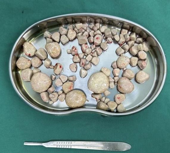 Cụ ông 80 tuổi mang trong mình hơn 100 viên sỏi bàng quang, bác sĩ đưa ra cảnh báo- Ảnh 1. Cụ ông 80 tuổi mang trong mình hơn 100 viên sỏi bàng quang, bác sĩ đưa ra cảnh báo- Ảnh 1.