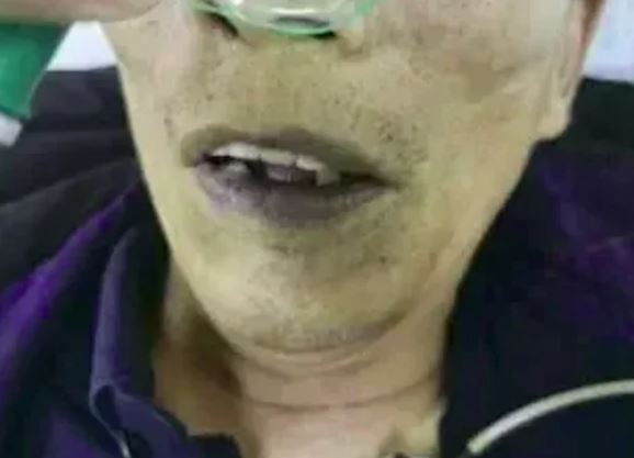 Sau khi ăn món khoái khẩu, người đàn ông 73 tuổi đột ngột ngã quỵ, toàn thân chuyển màu xanh- Ảnh 1. Sau khi ăn món khoái khẩu, người đàn ông 73 tuổi đột ngột ngã quỵ, toàn thân chuyển màu xanh- Ảnh 1.