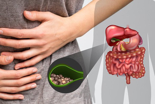 Chủ quan với sỏi túi mật, bệnh nhân 77 tuổi nhập viện cấp cứu vì tắc ruột- Ảnh 2. Chủ quan với sỏi túi mật, bệnh nhân 77 tuổi nhập viện cấp cứu vì tắc ruột- Ảnh 2.