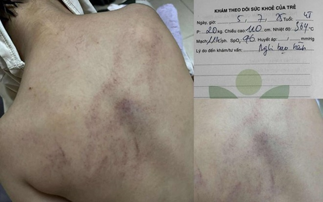 Điều tra vụ bé 6 tháng tuổi nghi bị bạo hành dẫn đến xuất huyết não ở Quảng Ngãi- Ảnh 2.