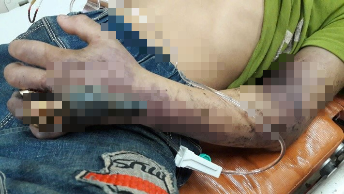 Bị rắn độc cắn, người đàn ông 50 tuổi tuổi tin thầy lang đắp thuốc lá "rước họa vào thân" - Ảnh 1.