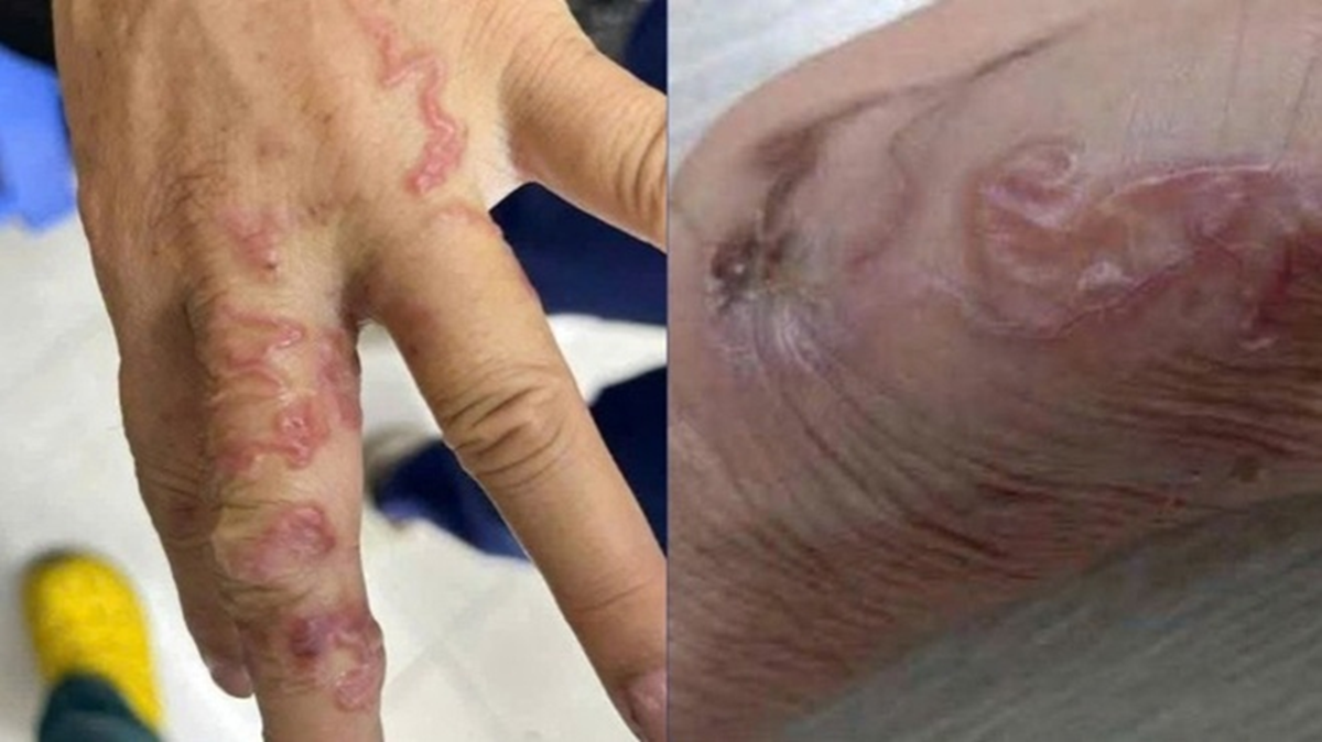 Sau bữa gỏi cá mè sống, người bệnh "sốc" khi thấy giun bò lổm ngổm dưới da - Ảnh 1.