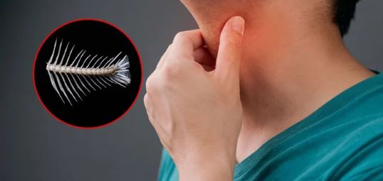 Người đàn ông 29 tuổi tử vong vì hóc xương cá - Ảnh 1.