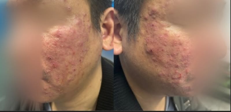 Tưởng mụn trứng cá, người đàn ông đi khám phát hiện "thủ phạm thầm lặng" gây bệnh- Ảnh 1.