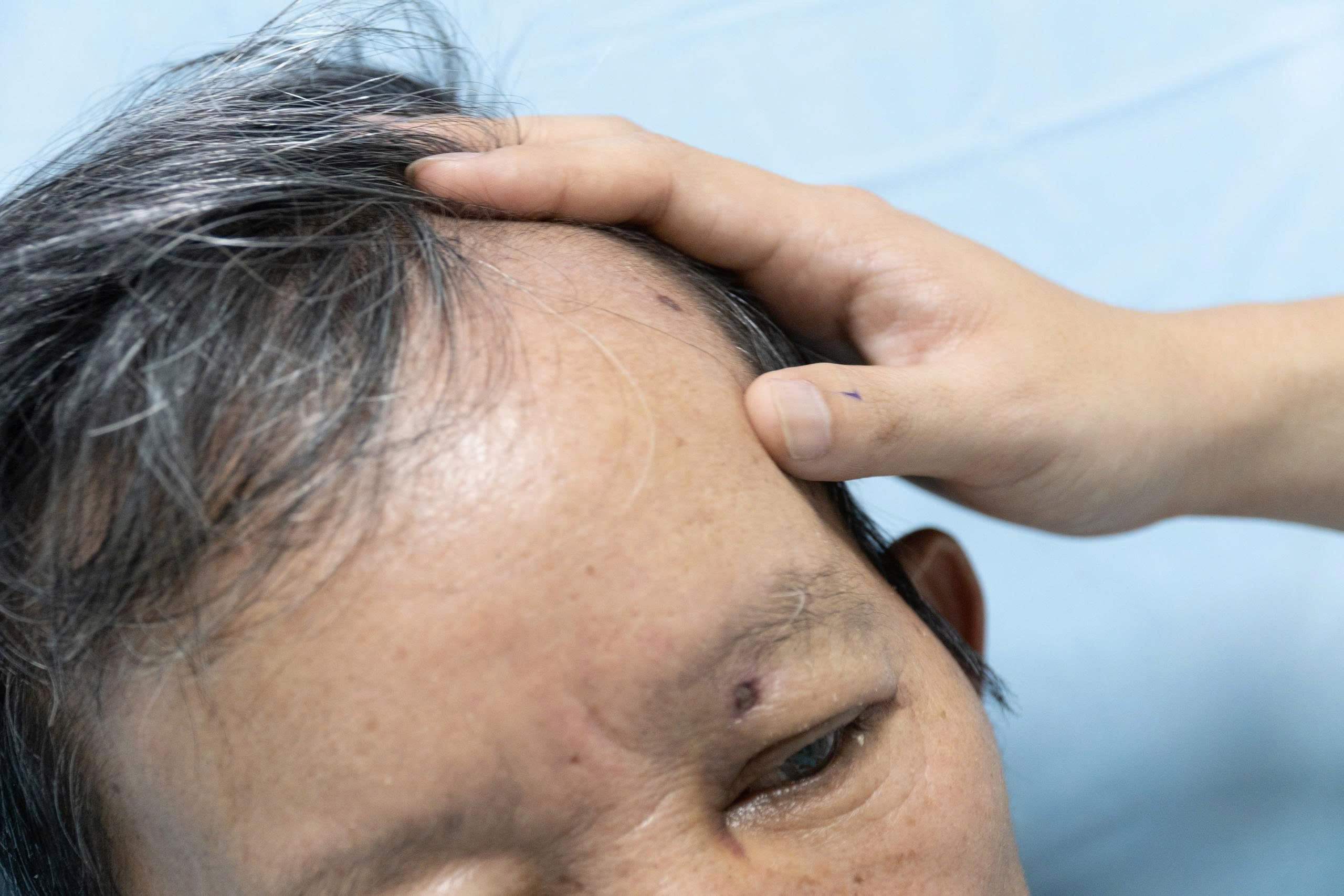 Bị hơn 30 vết ong vò vẽ đốt, người đàn ông thoát chết thần kỳ- Ảnh 1.