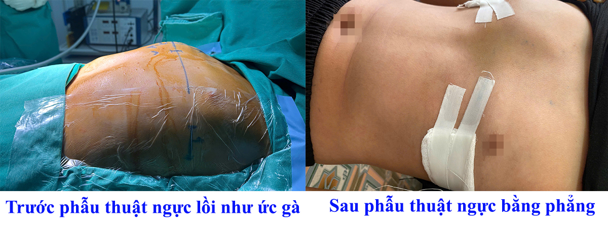 Bé trai 12 tuổi tự ti vì lồng ngực nhô cao như "ức gà" - Ảnh 1.