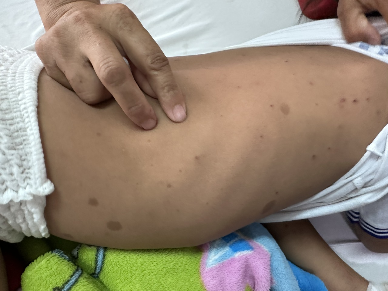 Cháu bé 7 tuổi nhập viện với 200 vết ong đốt gây bội nhiễm, tổn thương giác mạc  - Ảnh 1.
